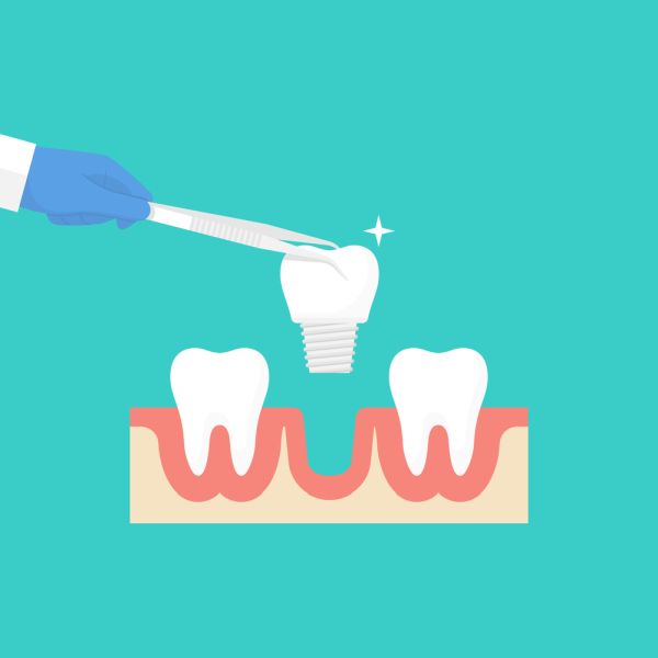 Facts You Should Know About Dental Implants