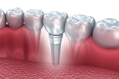 Who Should Perform Your Dental Implant Surgery?
