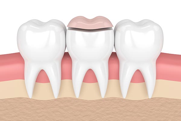 How a Cosmetic Dentist Can Place Inlays and Onlays from Aesthetic Dentistry of Noe Valley in San Francisco, CA