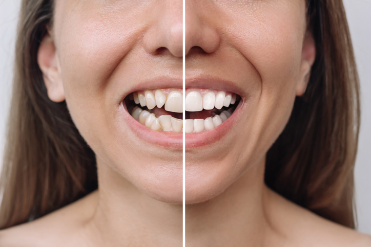 Veneers for Worn or Chipped Teeth