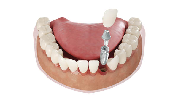 Cosmetic Options For Missing Teeth From An Implant Dentist