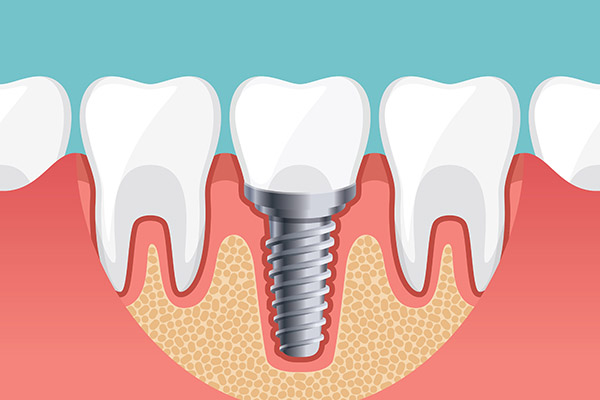Implant Dentistry Options To Replace A Single Missing Tooth