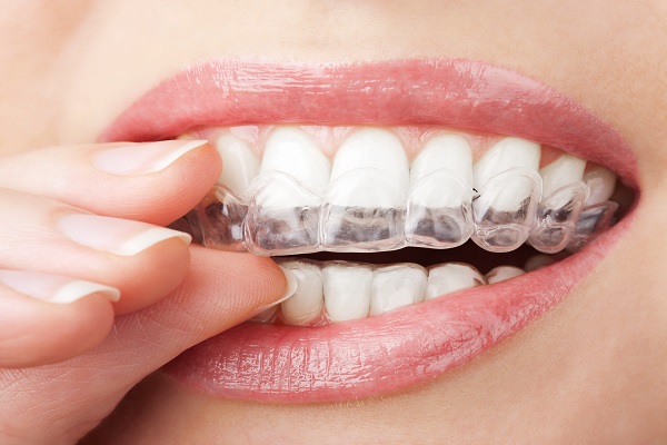 The Step By Step Process On How Invisalign Works