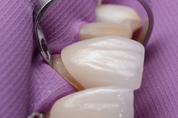 Getting Dental Lumineers For Tooth Cracks