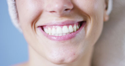 Visit A Cosmetic Dentist For A Teeth Whitening In San Francisco