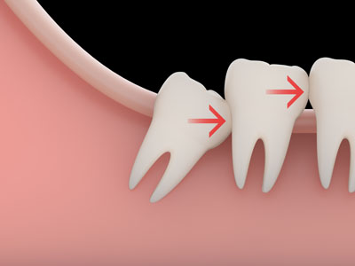 The Process Of Wisdom Teeth Extraction